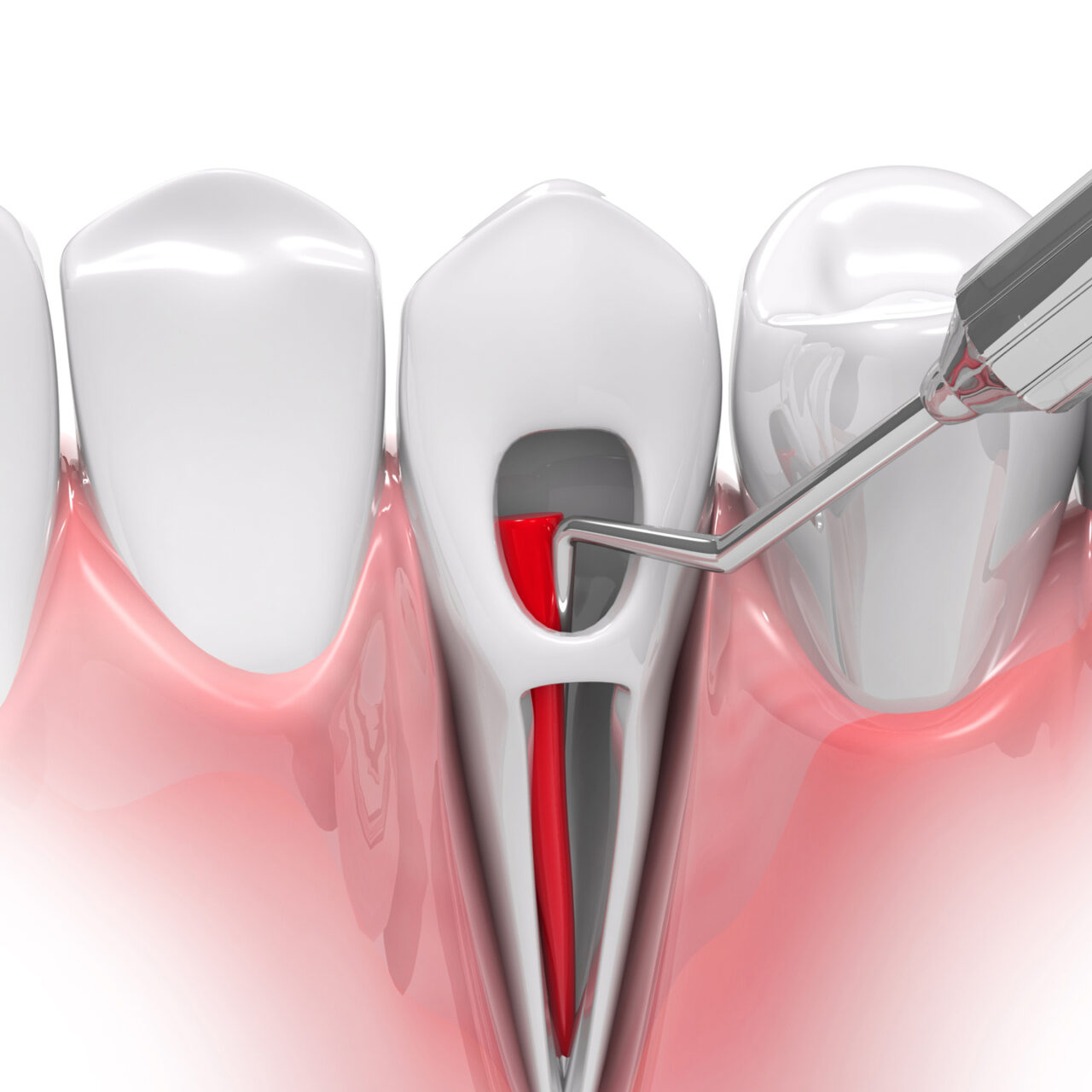 Root canal treatment process. 