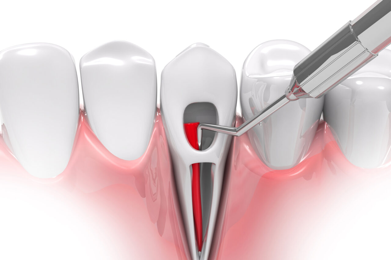 Root canal treatment process. 3d render