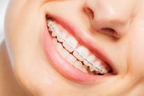 dental braces brampton